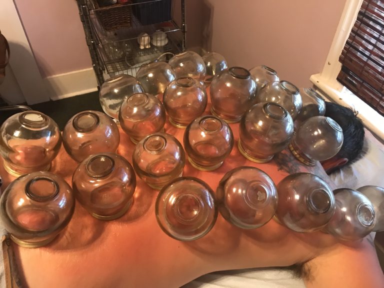 Cupping Technique Countryside Acupuncture